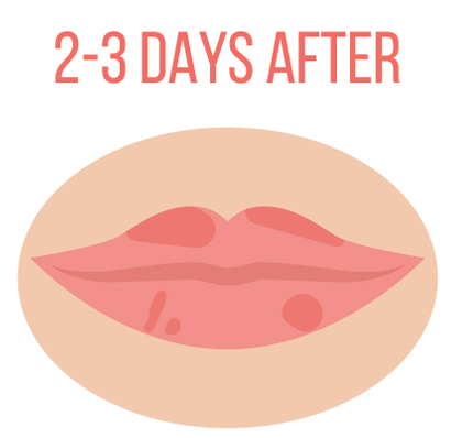 2-3days-lips